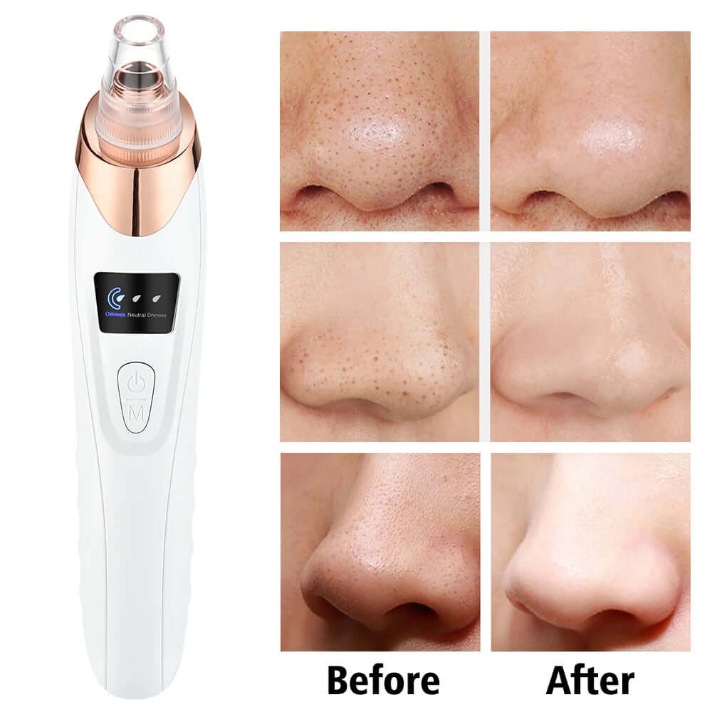 USB Rechargeable Blackhead Remover